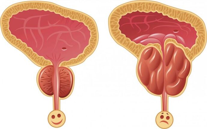 prostat yang sihat dan radang dengan prostatitis