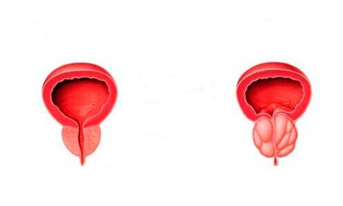 prostat yang sihat dan radang dengan prostatitis