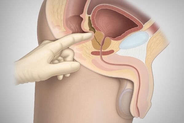 Urut prostat untuk prostatitis bakteria