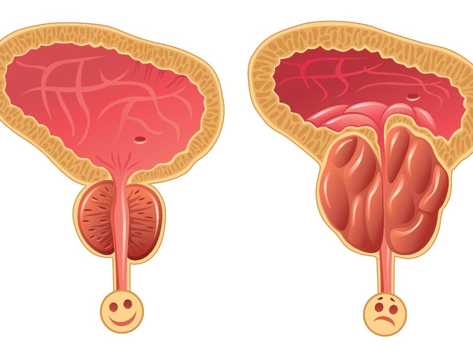 Kelenjar prostat yang sihat dan kesesakan prostat dengan prostatitis kongestif