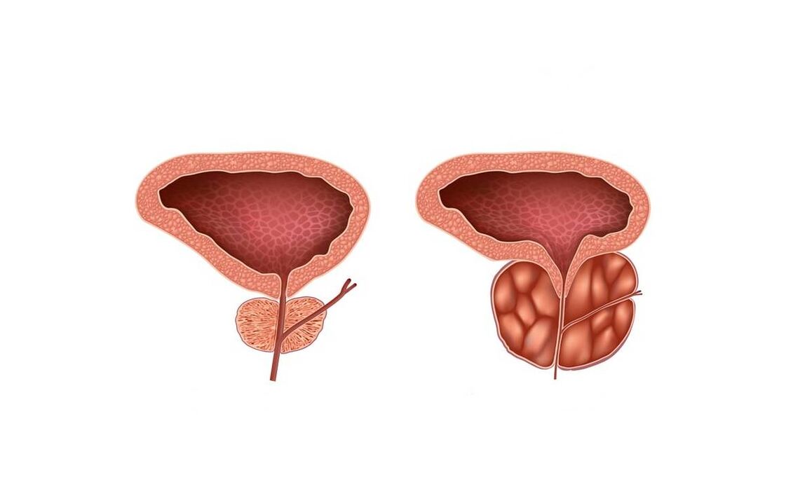 gejala prostatitis pada lelaki