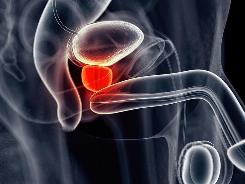 Keradangan kelenjar prostat yang mengiringi prostatitis kronik