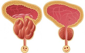 bagaimana prostatitis ProstEro berfungsi sebelum dan selepas rawatan
